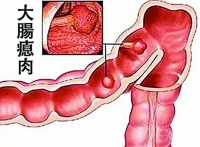 漫談中醫治大腸瘜肉